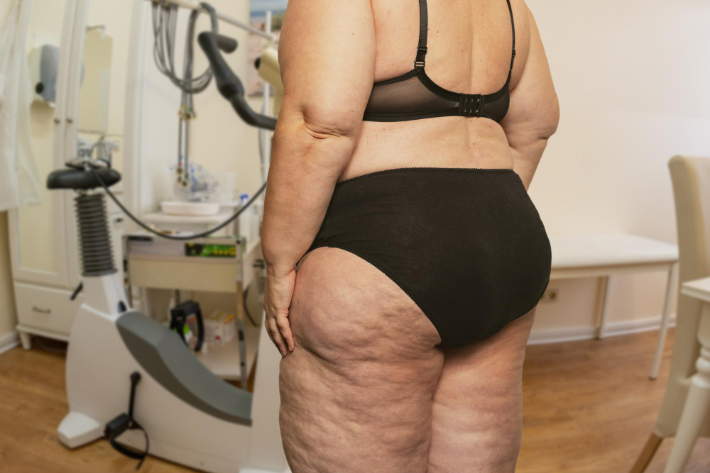 Lipedema Liposuction: What to Expect