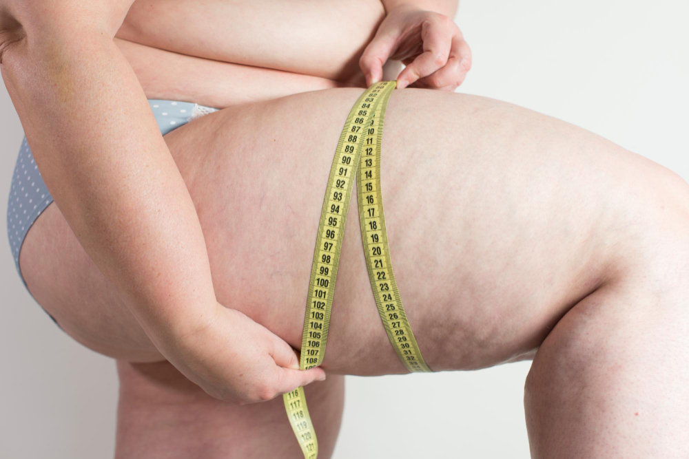 Non-Surgical Lipedema Treatments: What Actually Helps?