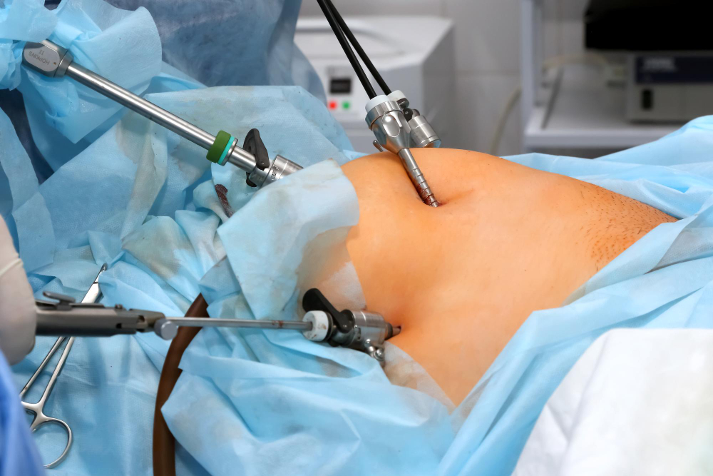Liposuction vs. Lipectomy for Lipedema