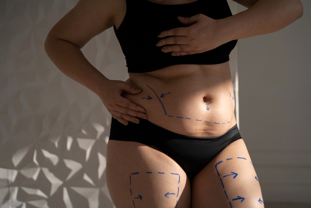 The Science of Lipedema Liposuction
