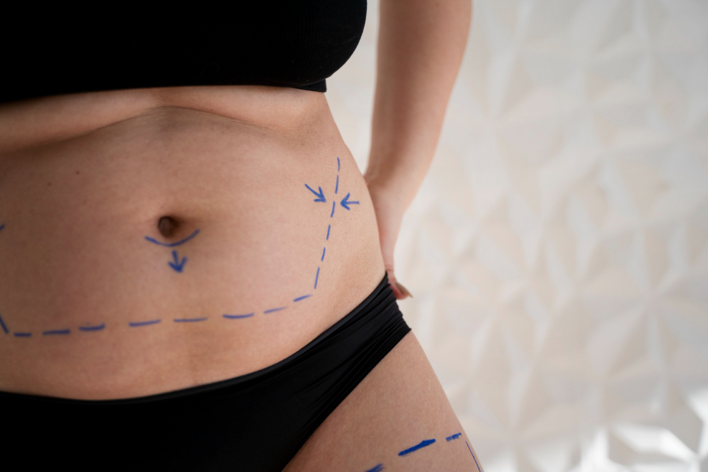 Is Liposuction Right for Lipedema?