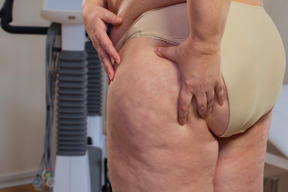 Why Lipedema Surgery Is a Medical Necessity, Not Vanity