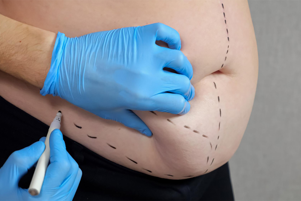 Lipectomy vs. Liposuction: What's the Difference?