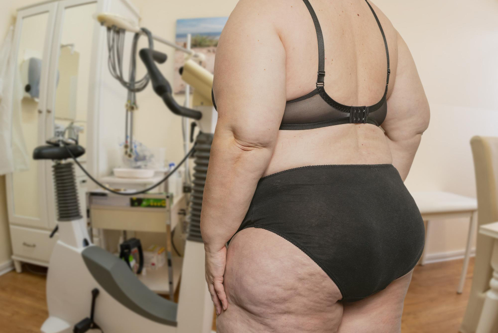 Questions to Ask Before Choosing a Lipedema Treatment Center