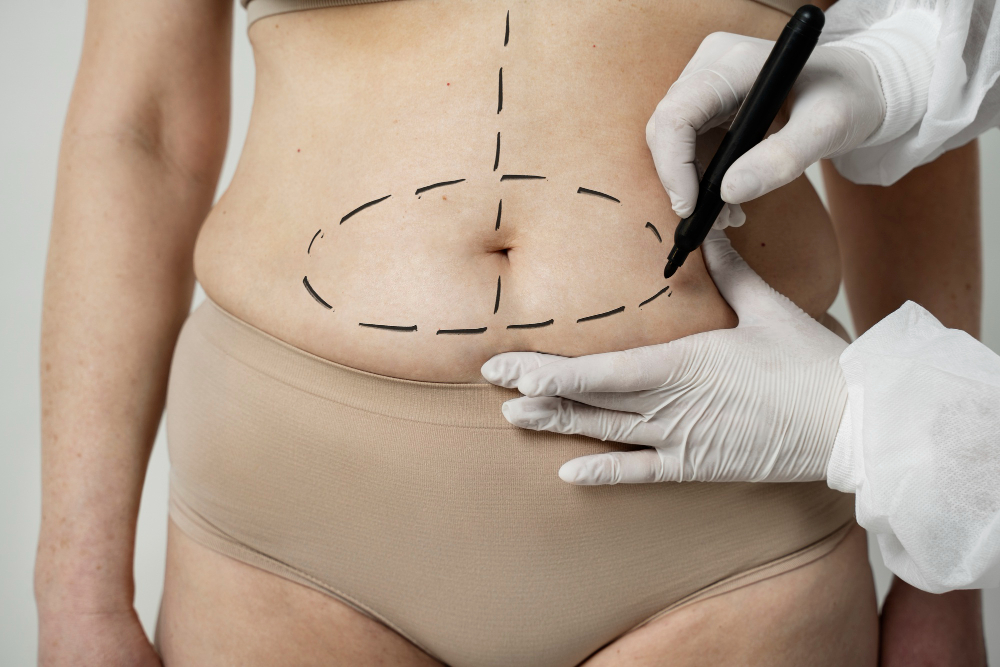How to Get Rid of Lipedema: A Guide for Misdiagnosed Patients in Roswell, GA