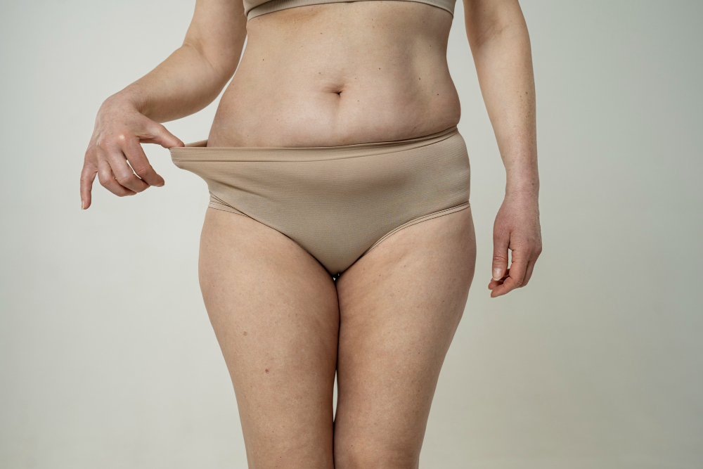 Lipedema Treatment in Florida: Options for Misdiagnosed Patients