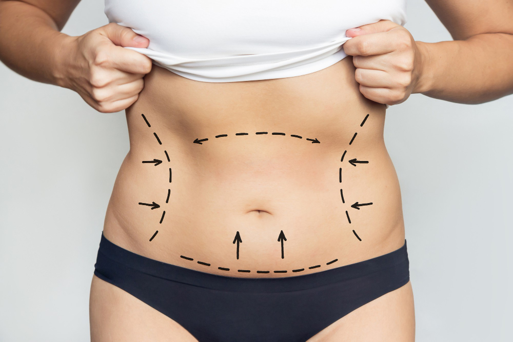 Lipedema Liposuction: Reducing Pain and Improving Mobility in Florida