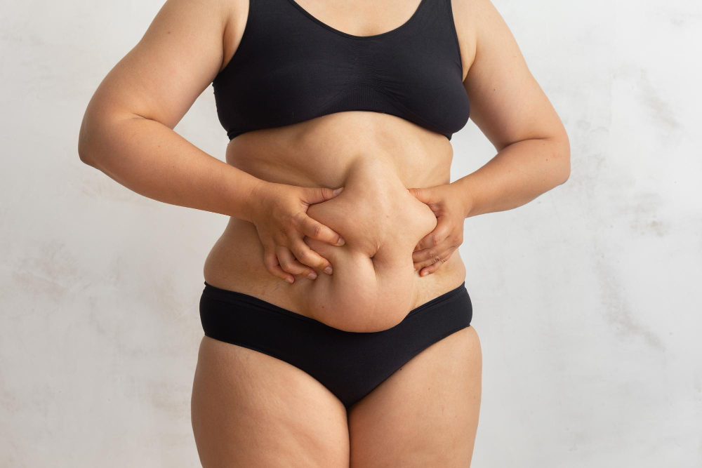 Lipedema Liposuction vs. Traditional Lipo: A Florida Guide