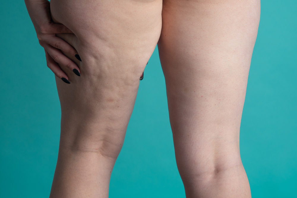 When Is Lipedema Surgery Recommended? A Patient Guide