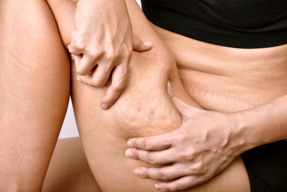 Lipedema or Just Fat Legs? How to Spot the Difference