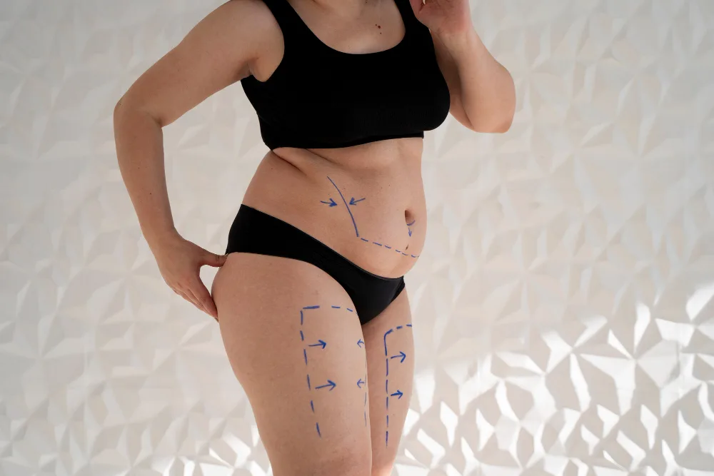 The Benefits of Lipedema Liposuction