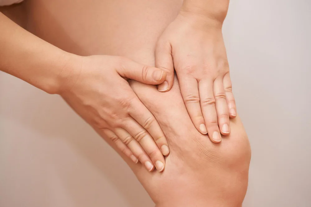 Lipedema as an Inherited Condition