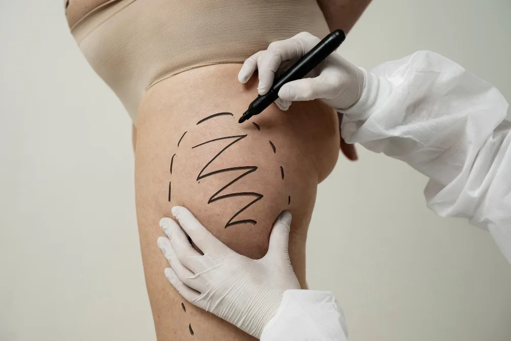 Recovering from Lipedema Surgery? Your At-Home Care Guide