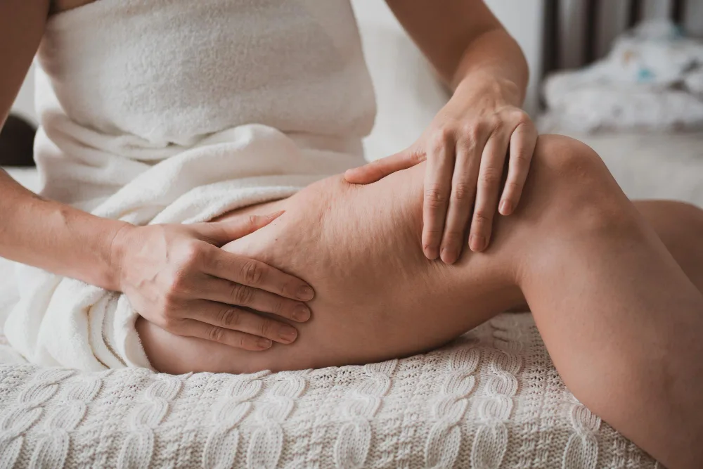 Effective Home Remedies to Fight Lipedema