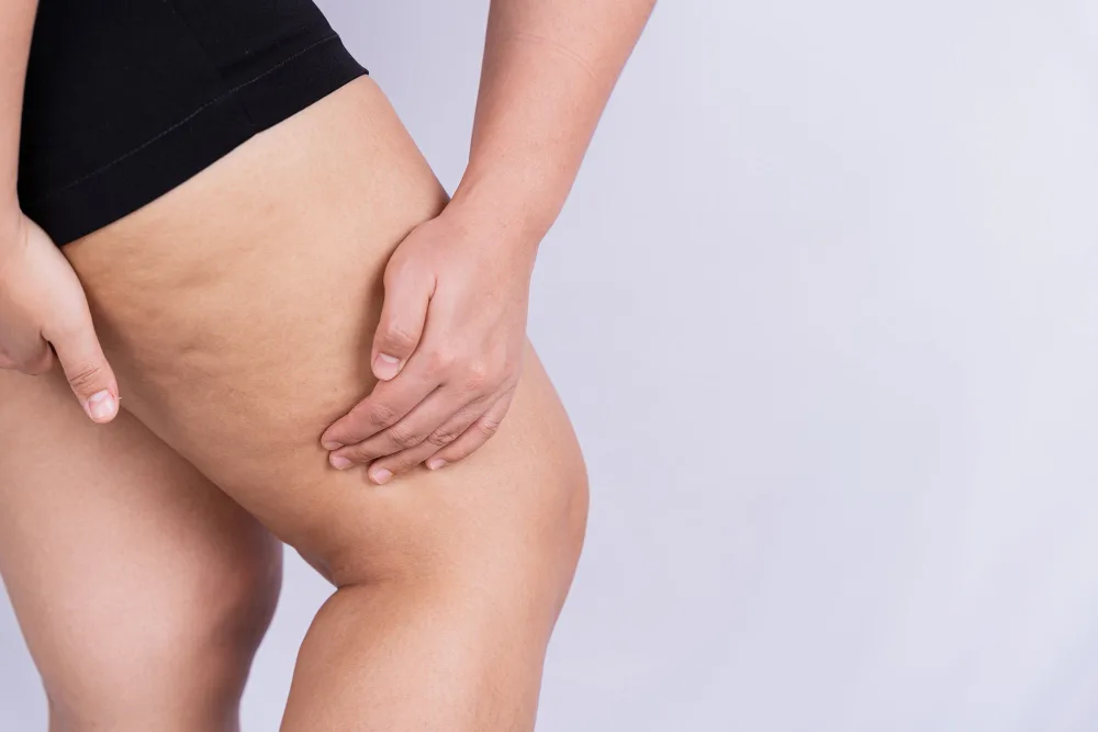 Lipedema or Just Fat Legs? Understanding the Difference
