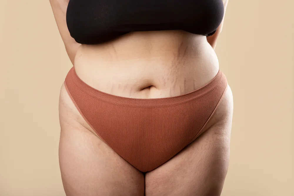 Lipedema Surgery in Orlando: Is It Right for You?