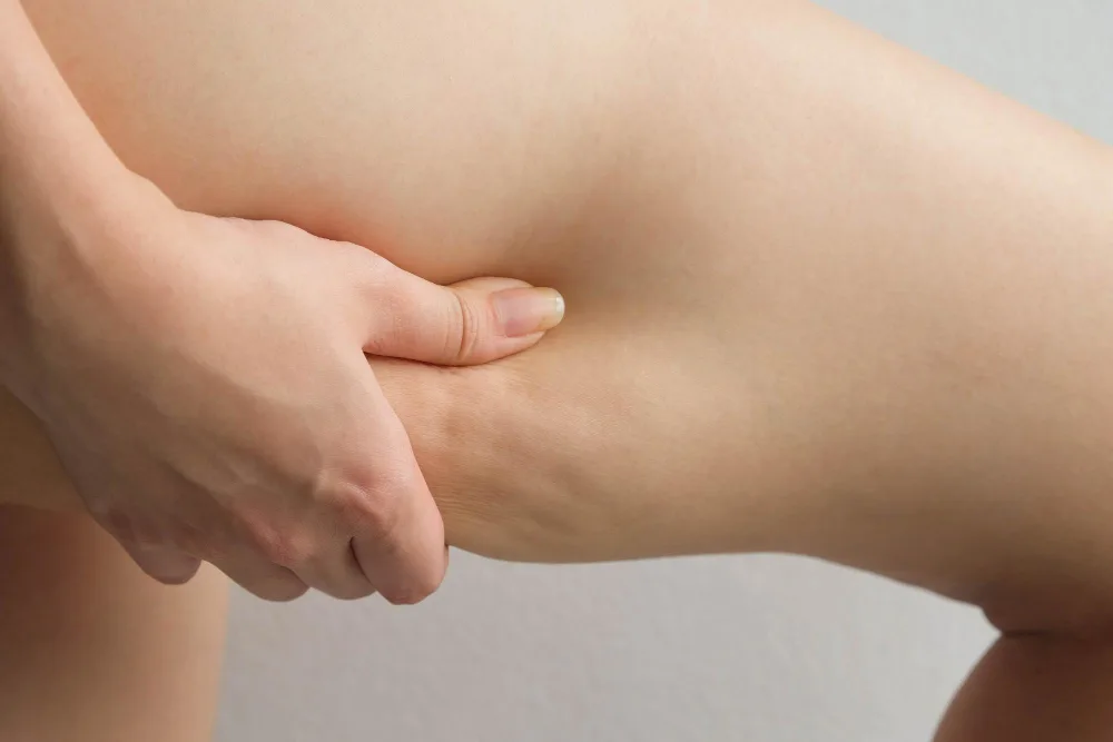 Understanding Lipedema: What Causes This Misunderstood Condition