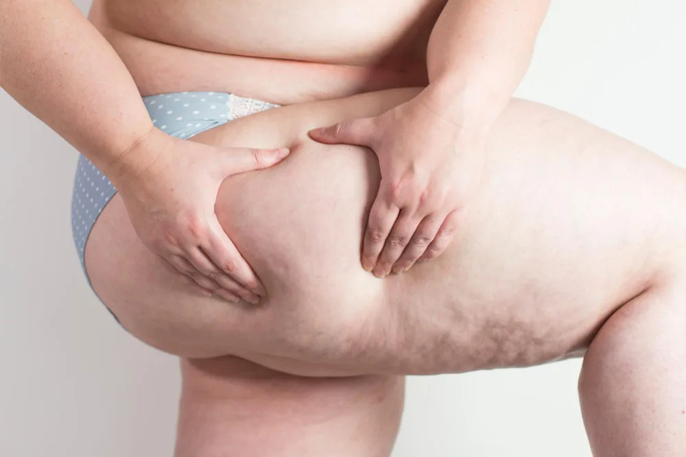 Lipedema Surgery vs. Liposuction: What's the Difference?