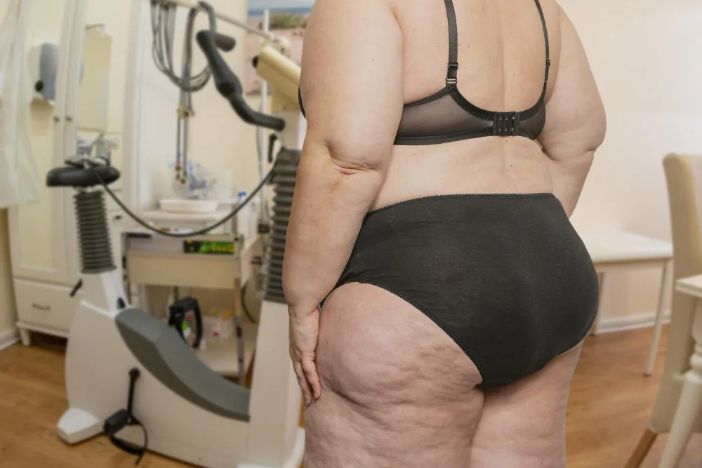 When Does Lipedema Require Advanced Treatment Plans?