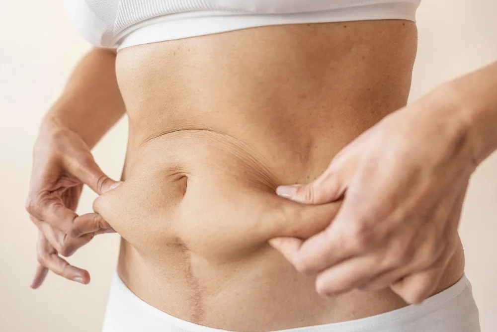 Understanding Lipedema: Symptoms, Stages, and Why Liposuction Helps