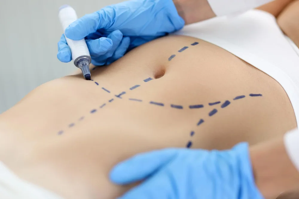 How to Choose the Right Surgery Center for Your Lipectomy