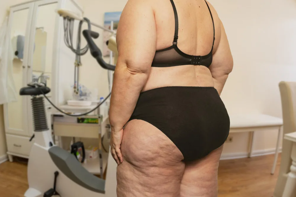 Understanding Lipedema Surgery Risks: A Complete Guide