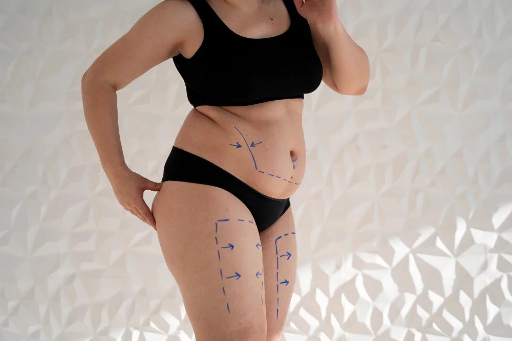 Lipedema Bruising Explained: Causes and Relief for Florida Women