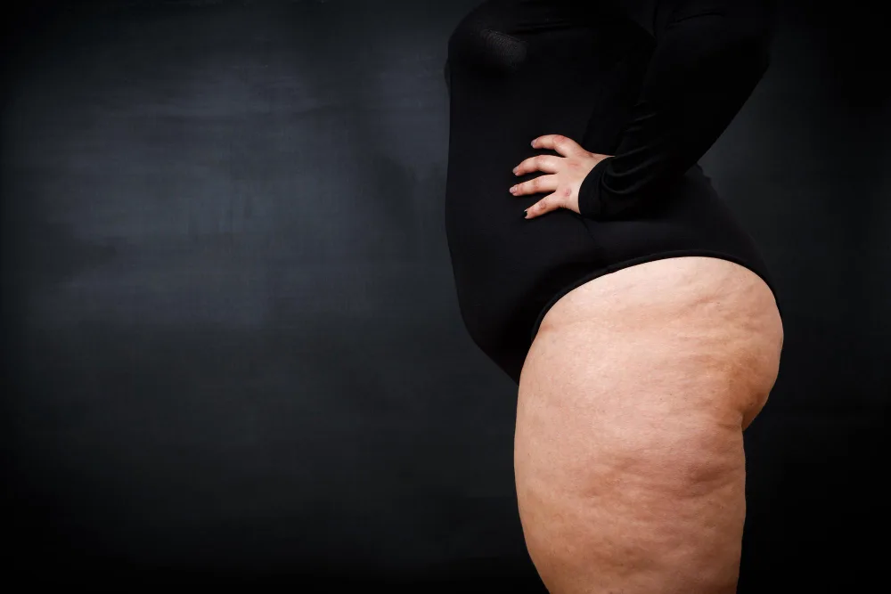 What Is Lipedema? Early Signs and Symptoms to Watch For