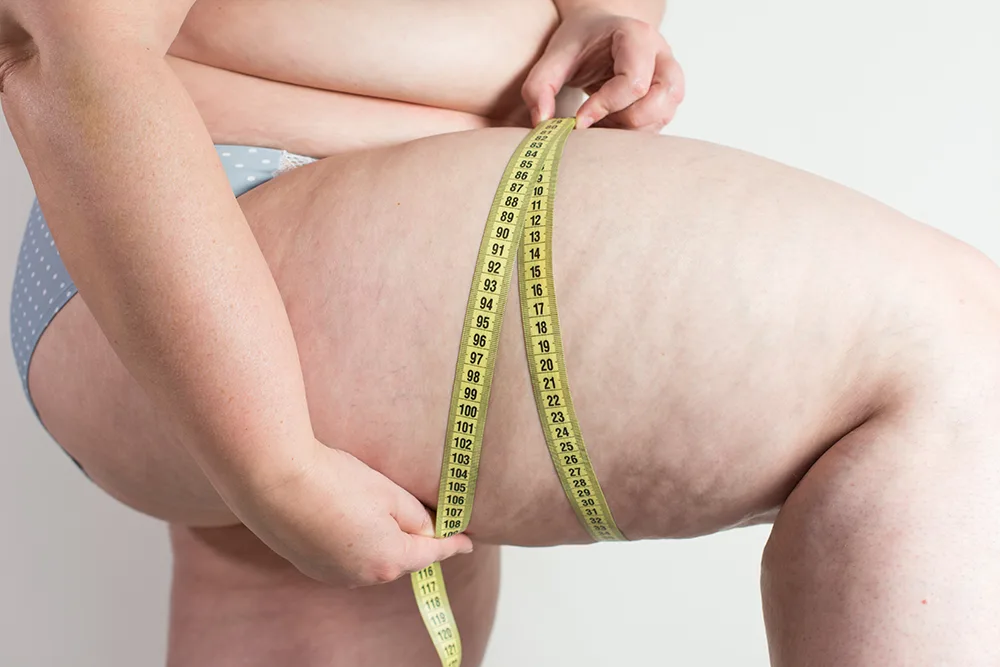Recognizing the Signs of Lipedema
