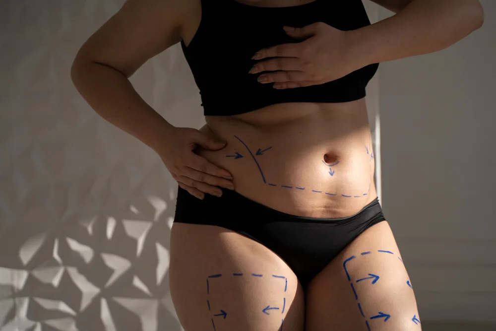 The Science of Lipedema Liposuction