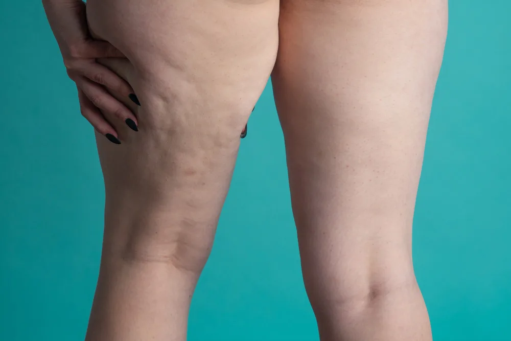 When Is Lipedema Surgery Recommended? A Patient Guide