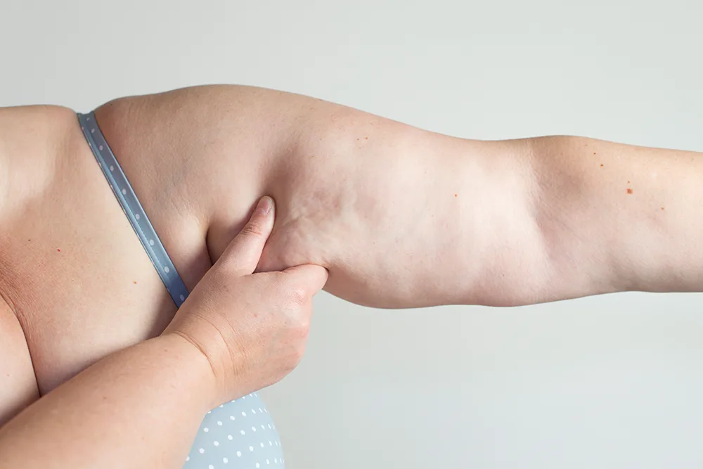 Understanding Lipedema Pain: How Liposuction Can Help