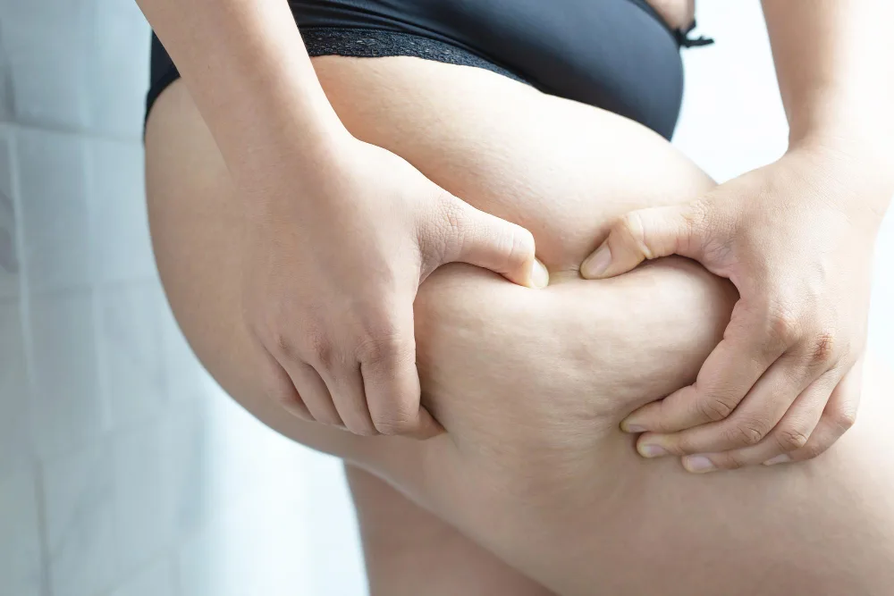 Managing Lipedema Fat: A Comprehensive Guide to Treatment Options and Relief