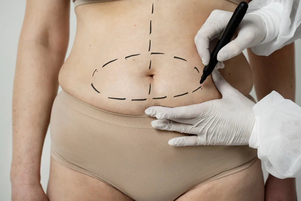 How to Get Rid of Lipedema: A Guide for Misdiagnosed Patients in Roswell, GA