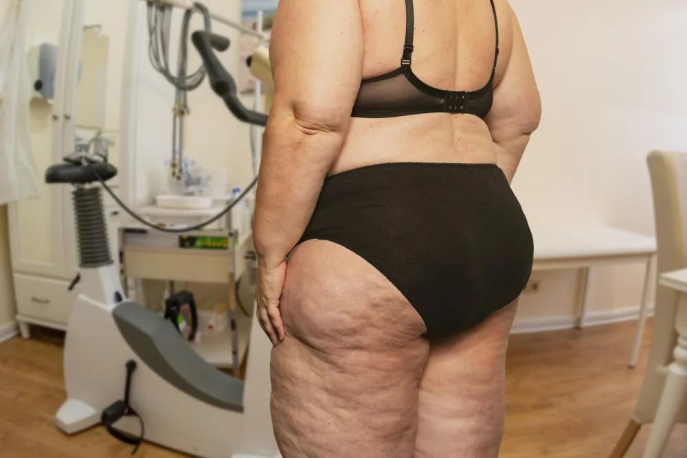 Lipedema Liposuction: What to Expect