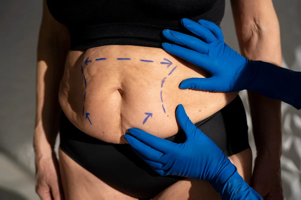 Specialized Liposuction for Lipedema Treatment
