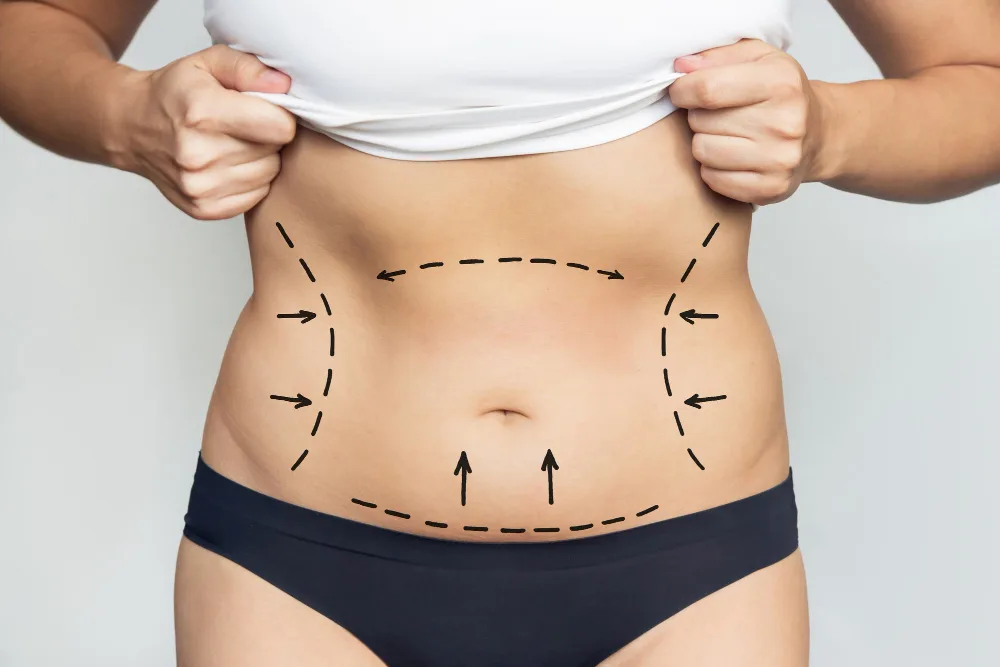 Lipedema Liposuction: Reducing Pain and Improving Mobility in Florida
