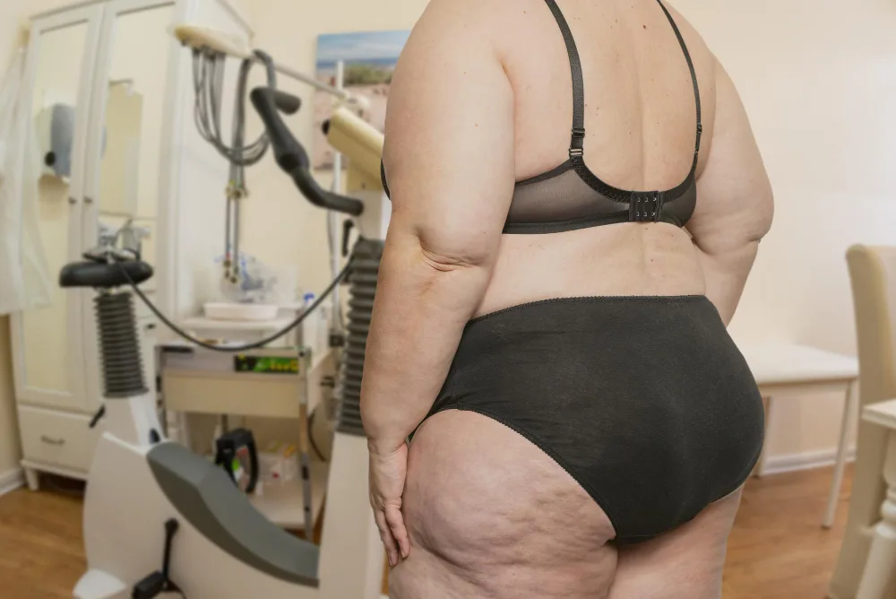 Questions to Ask Before Choosing a Lipedema Treatment Center