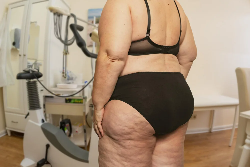 Lipedema Misdiagnosis: Signs, Symptoms, & the Path to Proper Treatment