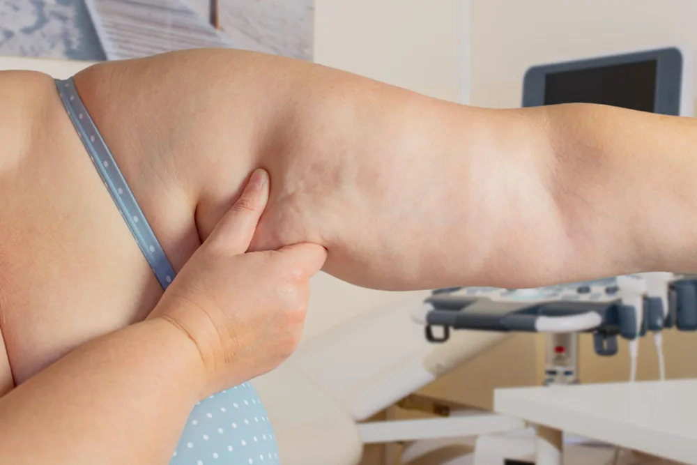 Understanding Lipedema Diagnosis and When to Consider Treatment