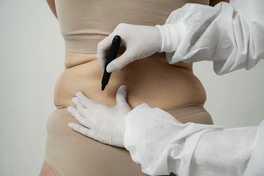 Second Opinion at a Florida Lipectomy Surgery Center: What to Know