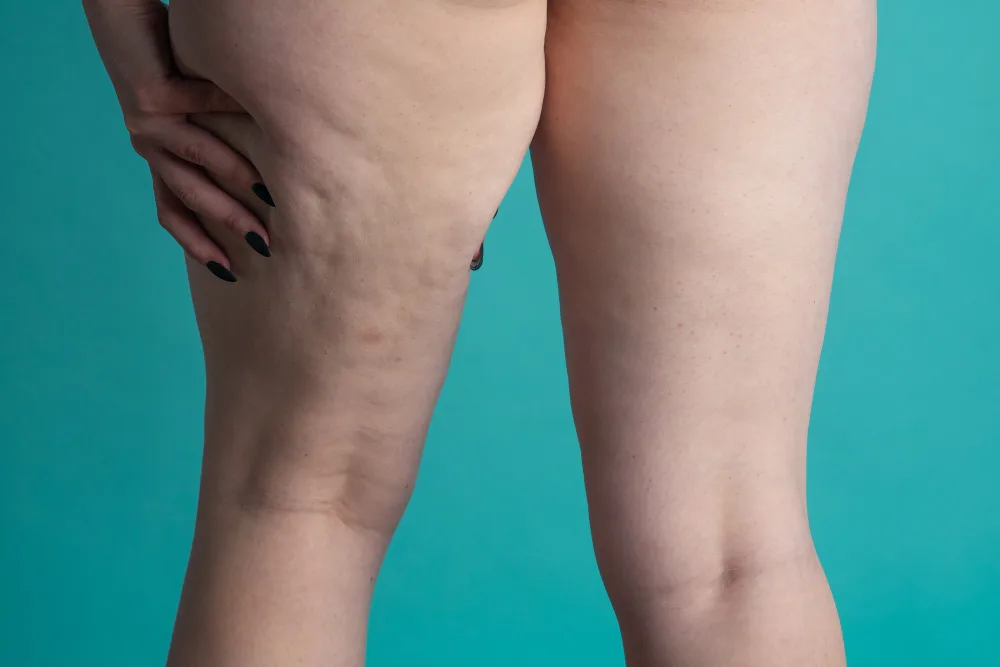 Lipedema vs. Normal Fat: Understanding the Difference and When to Seek Help